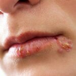 cold-sores-symptoms